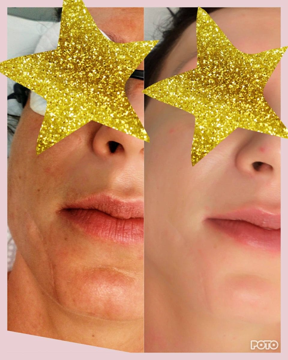 scar surgery scar surgery