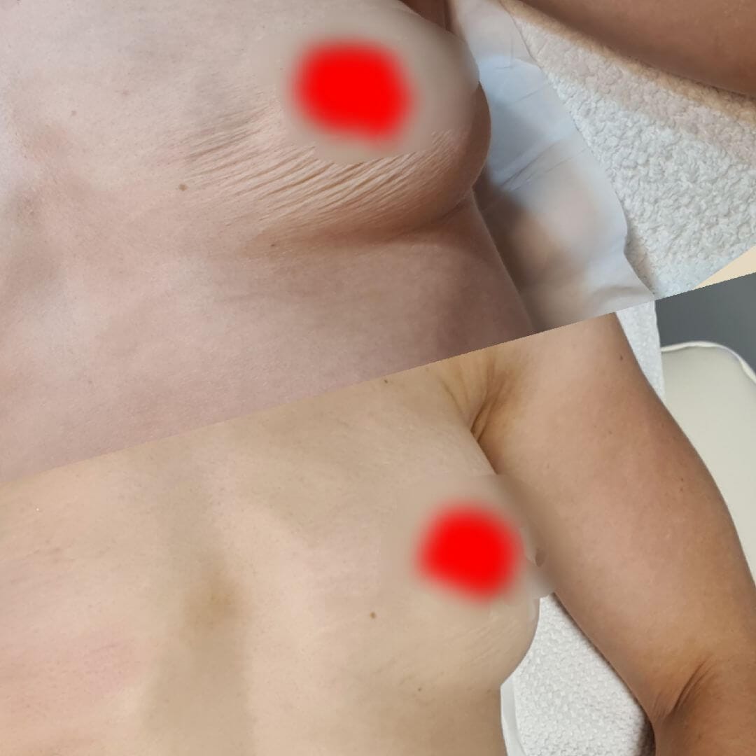 strawberry breast lift before and after